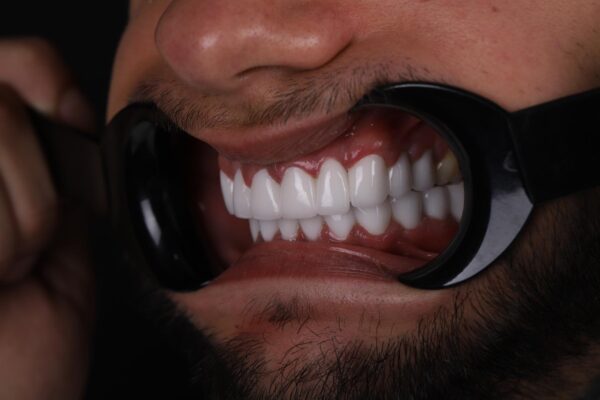 Final result of Hollywood Smile with laminate veneers in Turkey