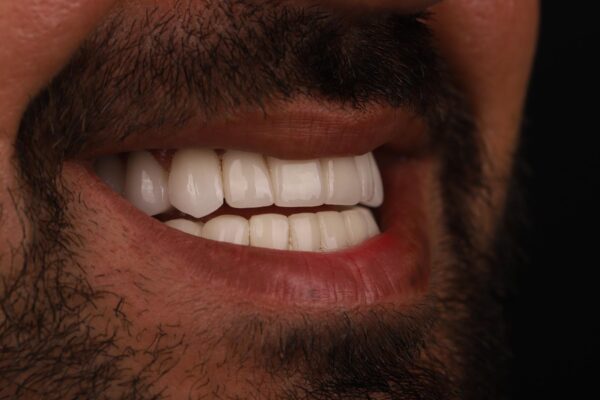 Final smile result after Hollywood Smile veneer makeover for a male patient
