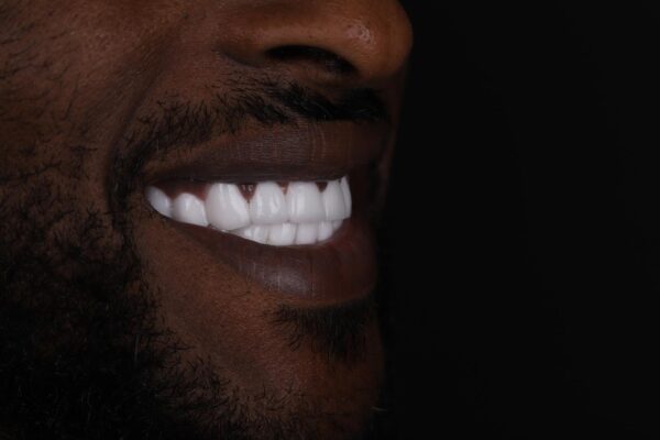 Final smile result after Hollywood Smile treatment for severe discoloration