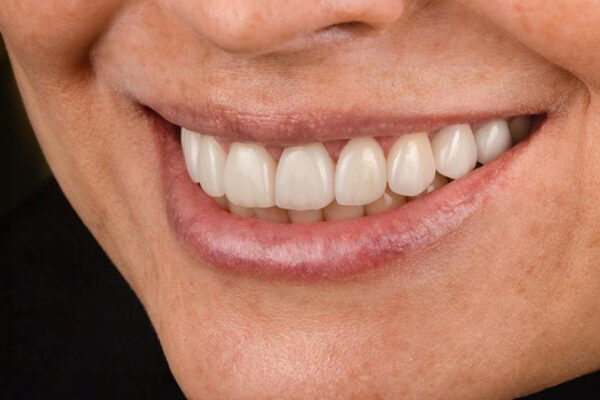 Final smile result of a female patient after laminate veneer treatment