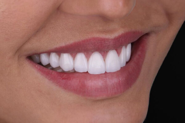 Final result after laminate veneers showing a natural and radiant smile