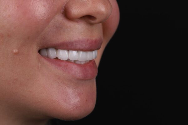 Final result after smile design correcting discoloration in Turkey