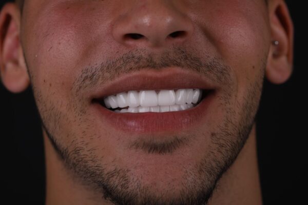 Front view of smile makeover result for chipped teeth in Turkey