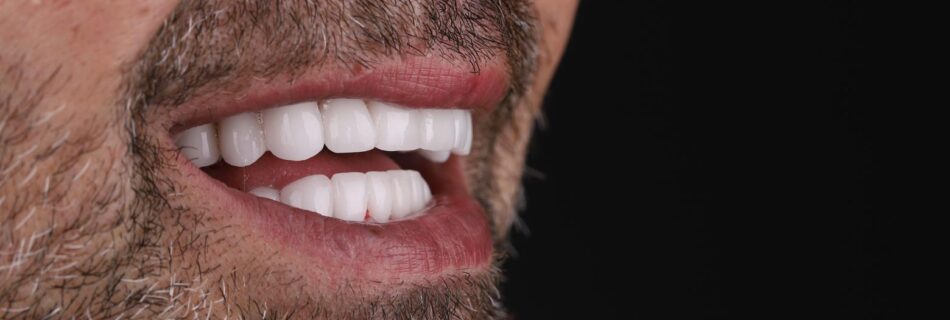 Final smile result after makeover for discolored teeth in Turkey – side profile