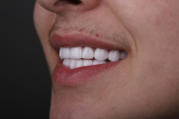 Final side view result after smile makeover for enamel defect correction