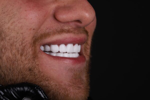 Hollywood Smile result for uneven teeth correction in Turkey – side profile