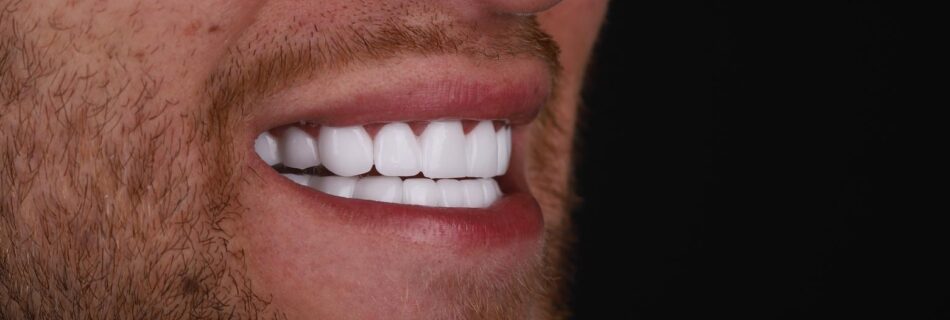 Hollywood Smile result for uneven teeth correction in Turkey – side profile