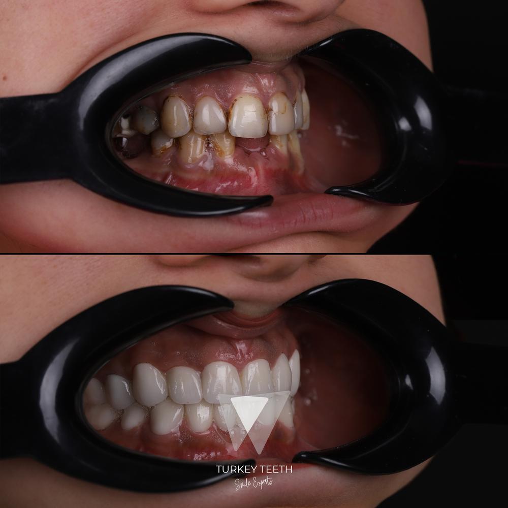 Before and after zirconium crown restoration in Turkey